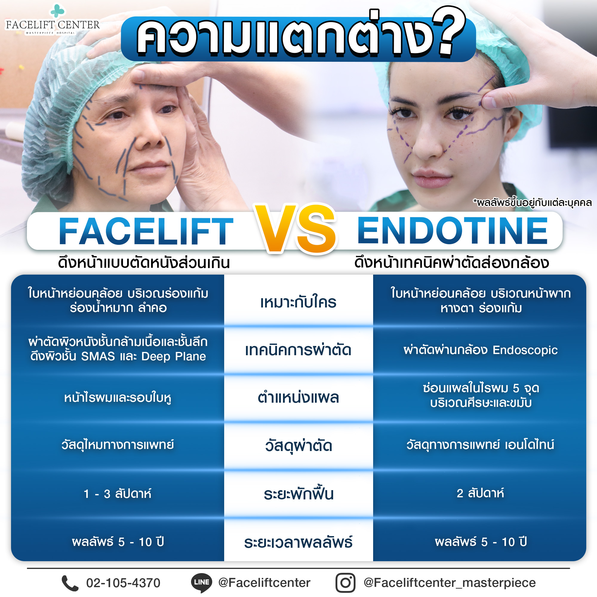ความแตกต่างFacelift Vs Endotine